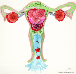 endometriosis